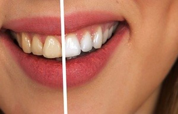 כמה זמן מחזיקים שתלים בשיניים?